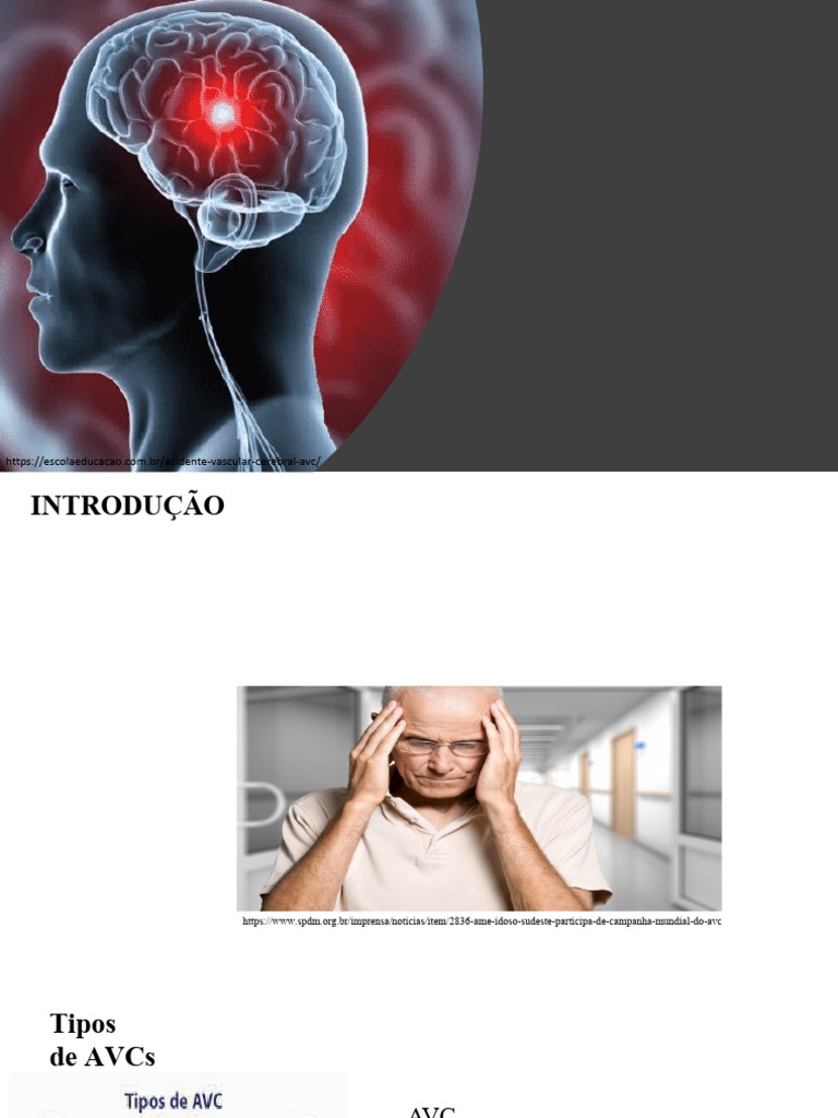 Acidente Vascular Cerebral (Avc) 1 | PDF | AVC | Doenças e distúrbios