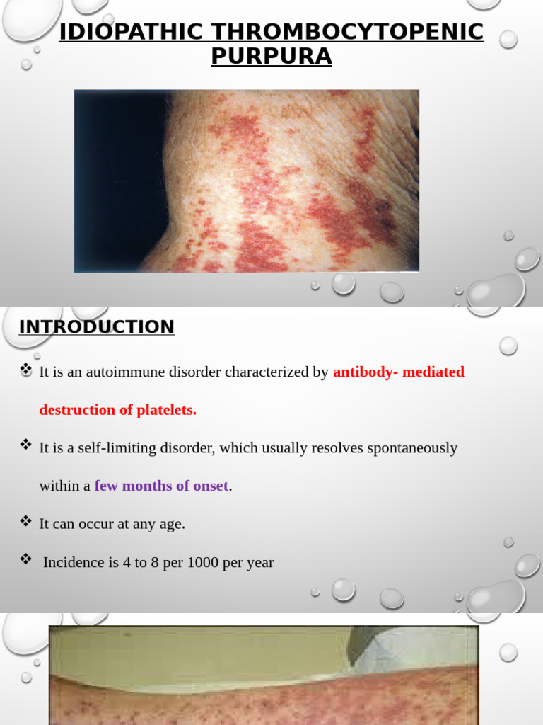 Idiopathic Thrombocytopenic Purpura Overview | PDF | Clinical Pathology ...