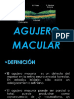 Agujero Macular: Definición, Etiología y Tratamiento