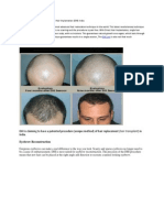 Direct Hair Transplantation (DHI) in India - Cost and Review