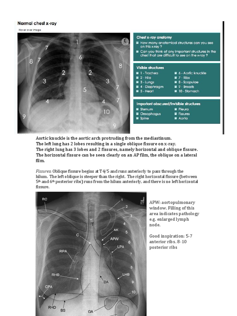 Chest x Ray Basics Lung Anatomical Terms Of Location
