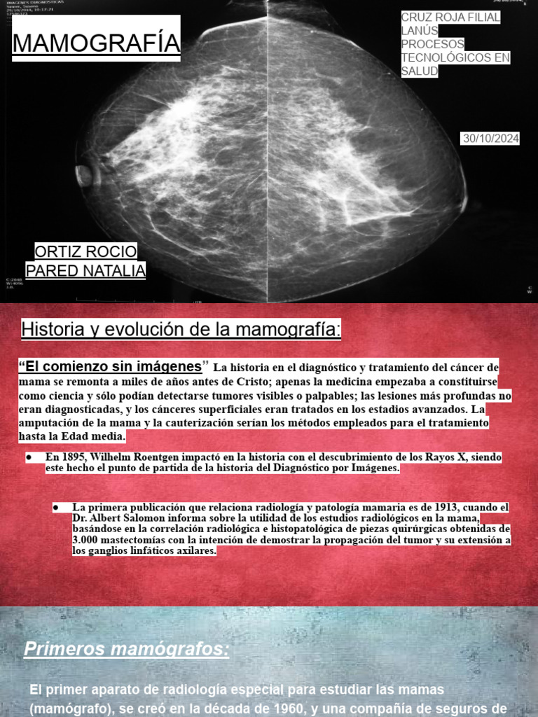 MAMOGRAFÍA terapia | PDF | Mamografía | Cáncer de mama