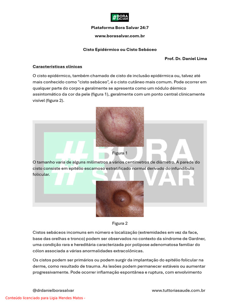 Cisto Sebceoou Cisto Epidermoide | PDF | Pele | Doenças e distúrbios