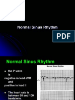 Normal Sinus Rhythm