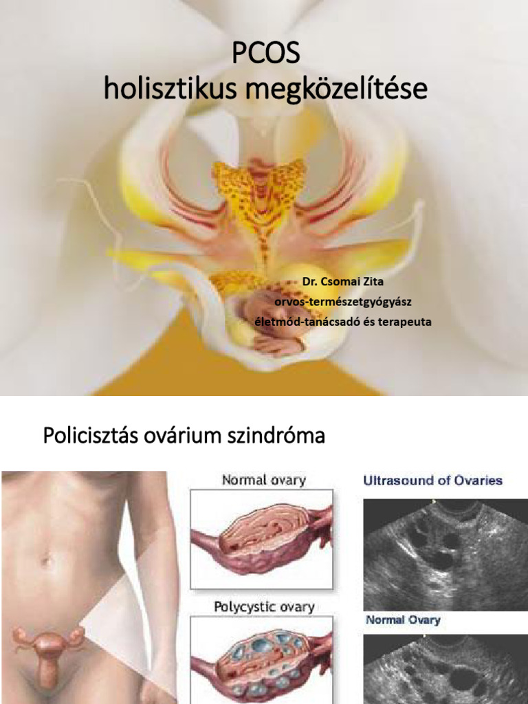 PCOS | PDF