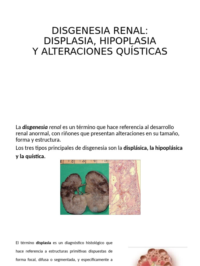 Disgenesia Renal | PDF | Riñón | Sistema urinario