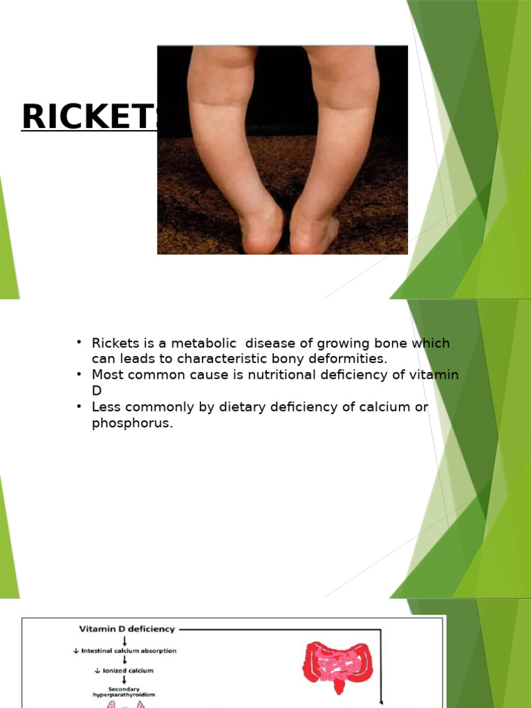 Rickets in Children: Causes and Effects | PDF