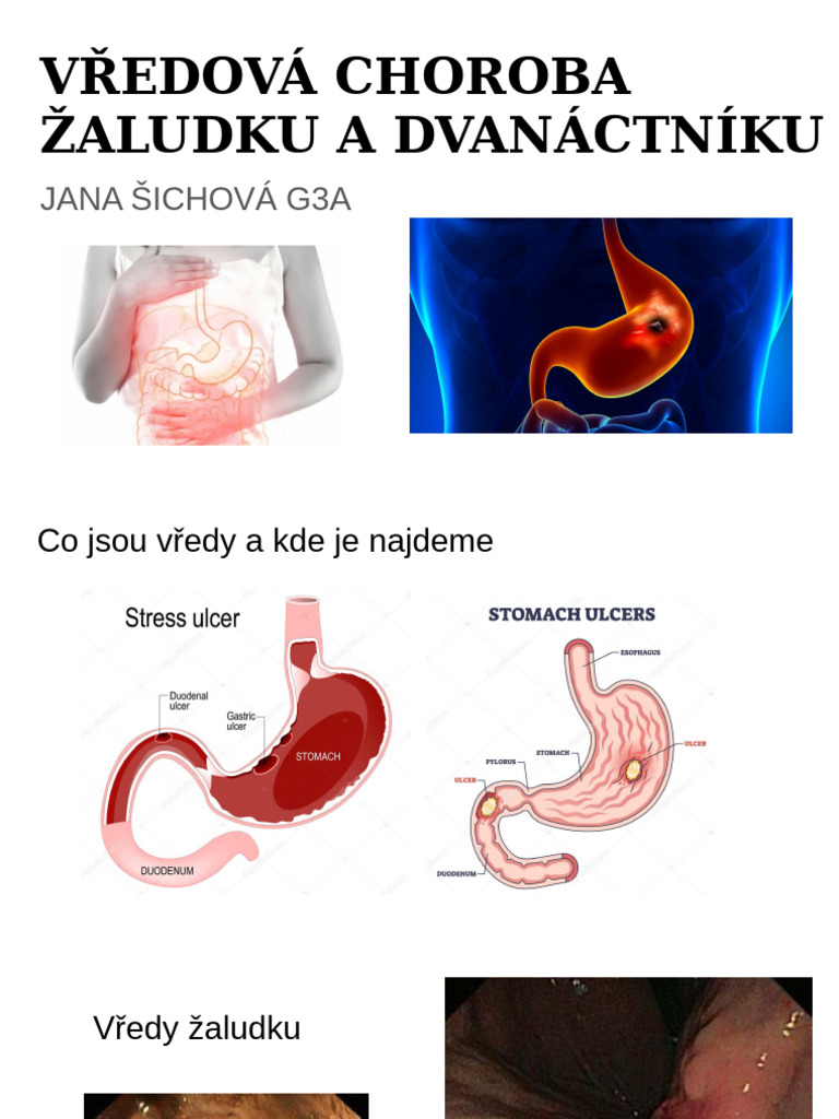 Vředová Choroba | PDF