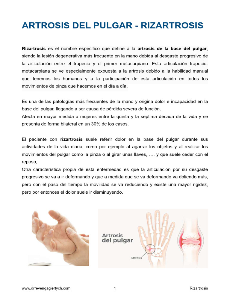 Tratamiento de la Rizartrosis | PDF | Osteoartritis | Medicina
