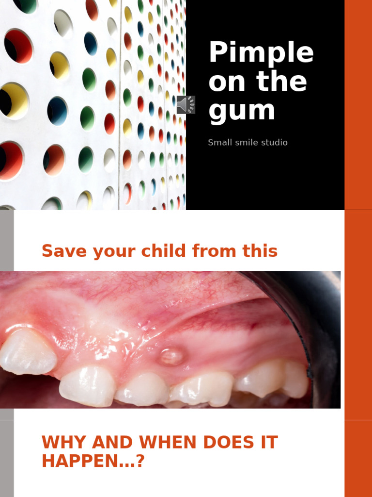 Pimple On The Gum | PDF