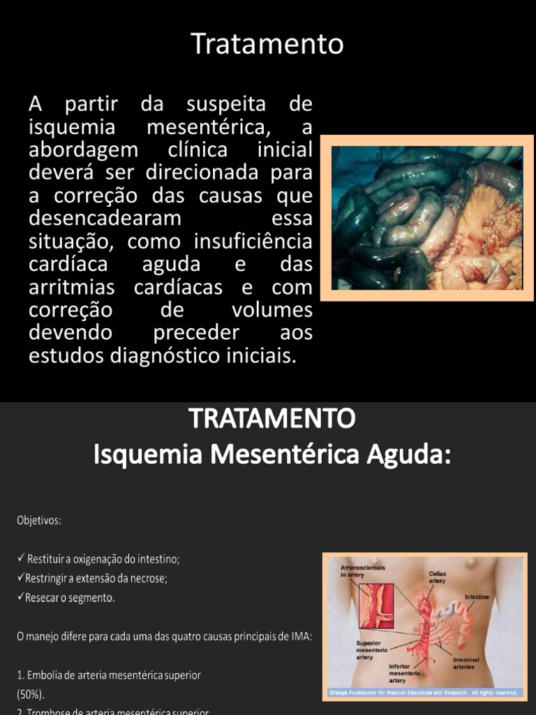Tratamentos para Isquemia Mesentérica | PDF