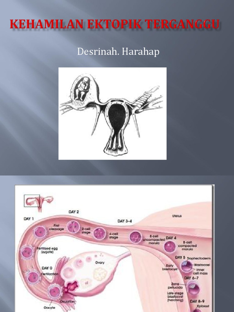 KEHAMILAN EKTOPIK TERGANGGU