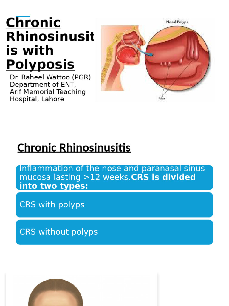 Chronic Rhinosinusitis with Polyps Guide | PDF | Human Nose ...