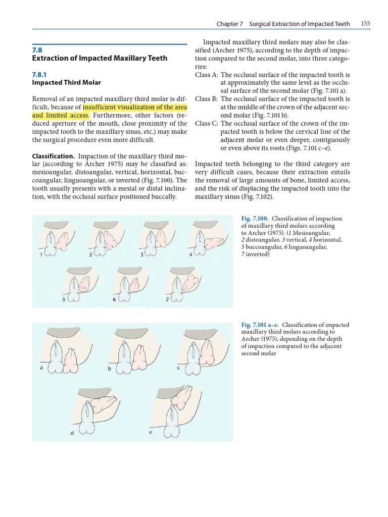 Extraction Techniques for Impacted Teeth | PDF | Tooth | Dentistry