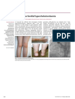 Homozygous Familial Hypercholesterolaemia