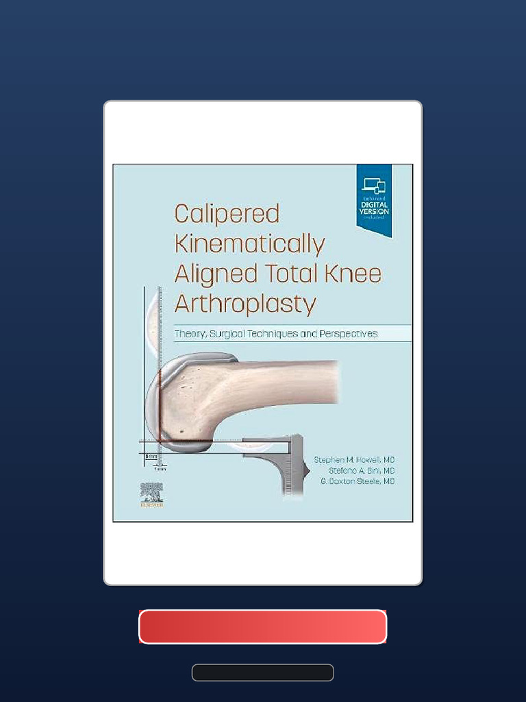 Calipered Kinematically Aligned Total Knee Arthroplasty Theory Surgical ...