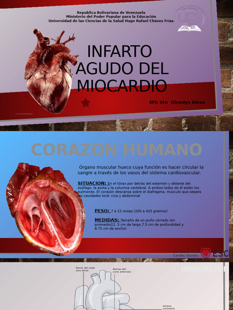Infarto Agudo de Miocardio: Causas y Tratamiento | PDF | Infarto de ...