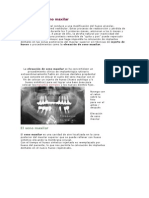 Elevación de Seno Maxilar