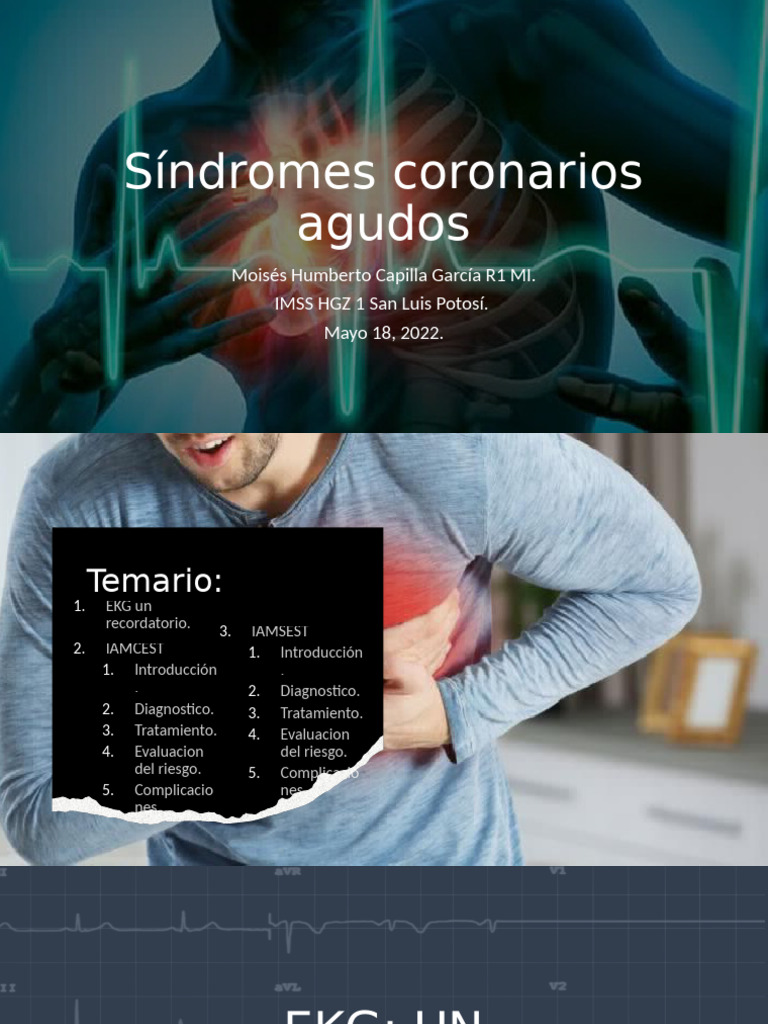 Sca 2 | PDF | Infarto de miocardio | Especialidades Medicas