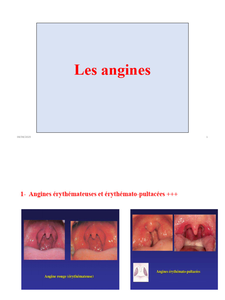 Types et traitements des angines et otites | PDF | Maladies et troubles ...