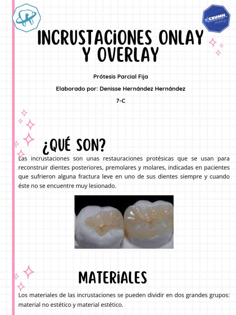 Incrustaciones Onlay y Overlay Dentales | PDF | Ramas de Odontología