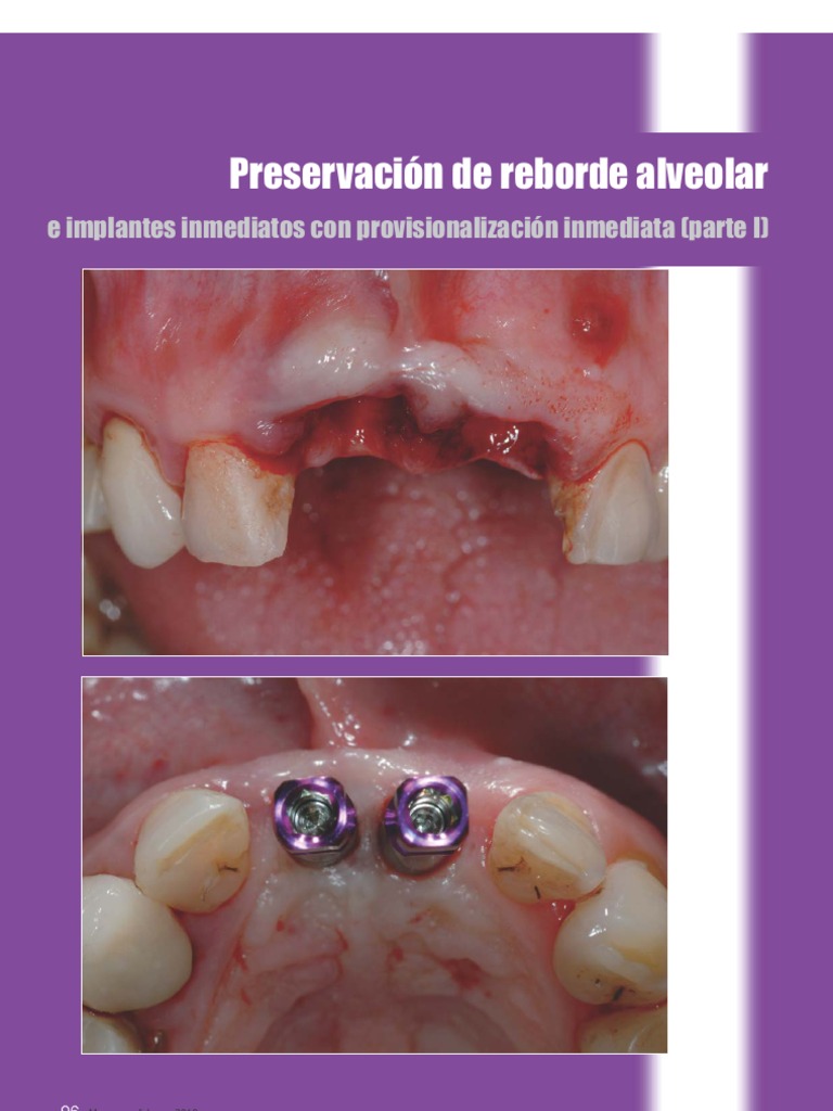 Regularizacion Del Reborde | PDF | Odontología | Diente humano