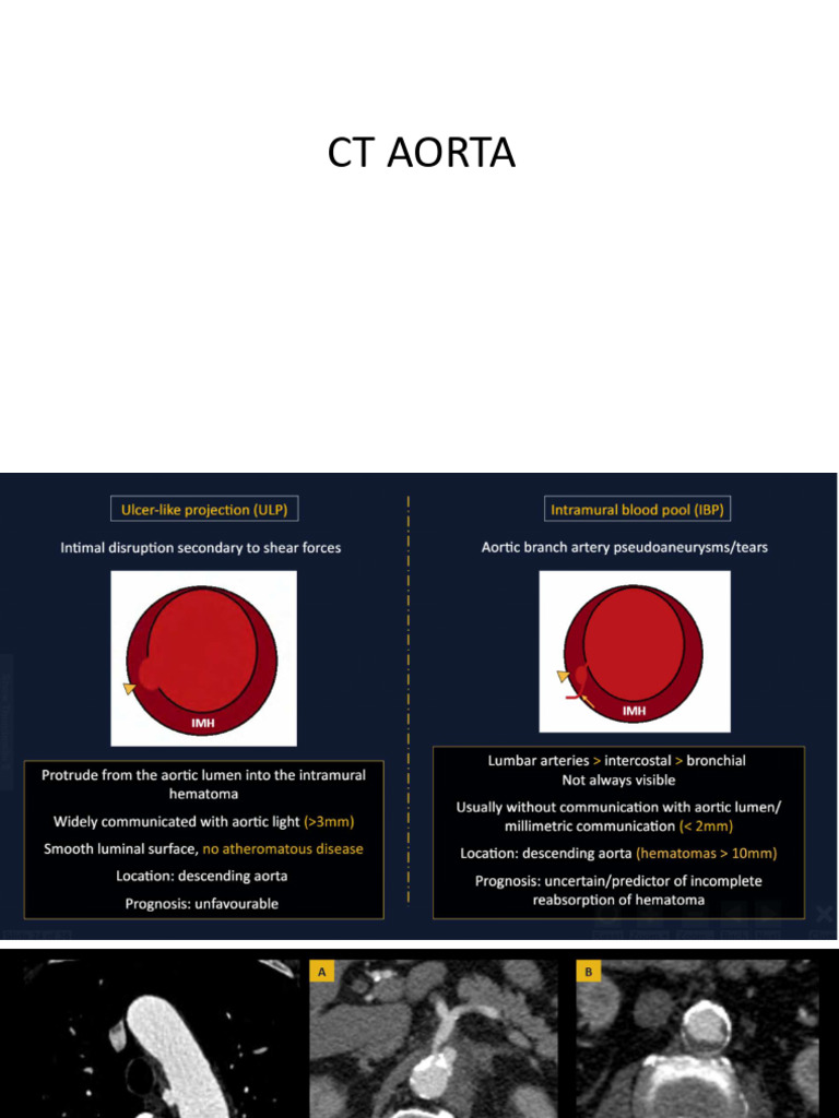 CT Aorta | PDF