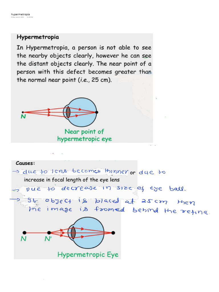 2) Hypermetropia 250609 144524 | PDF