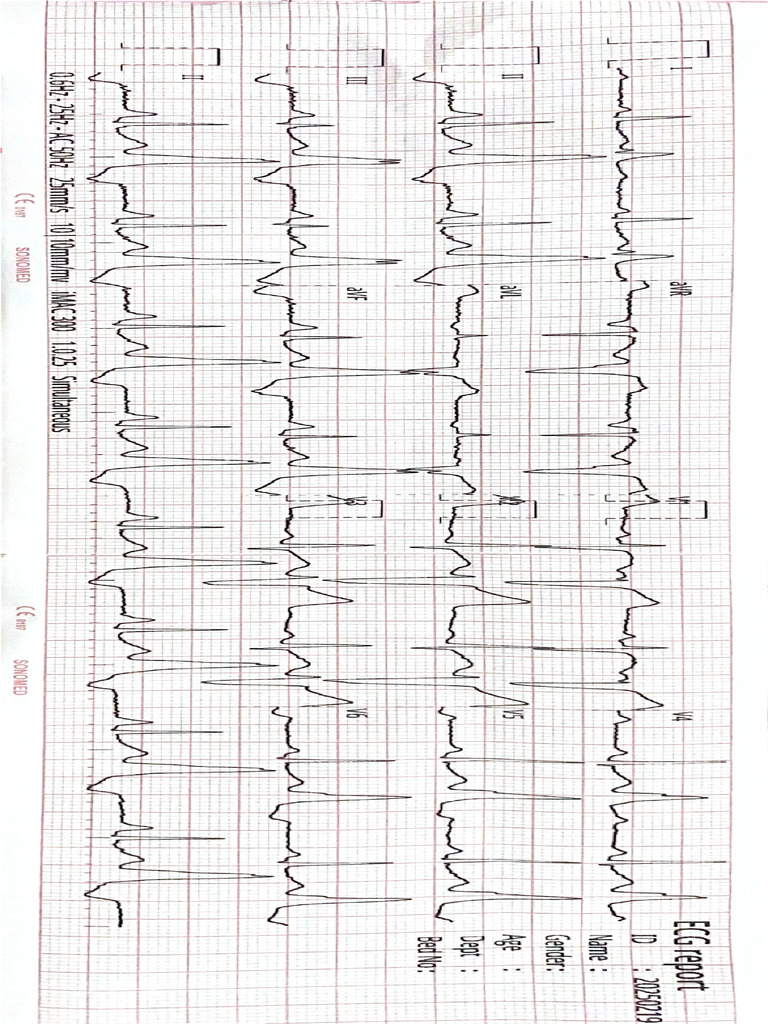 ECG Report | PDF