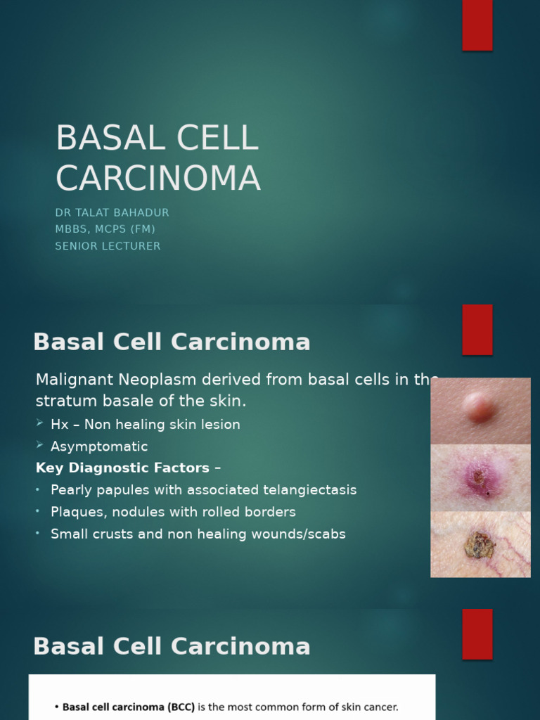 Basal Cell Carcinoma | PDF