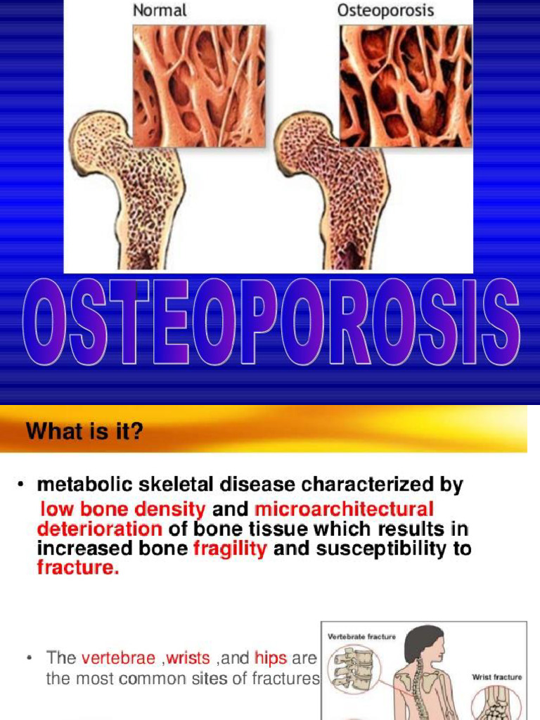 Osteoporosis | PDF
