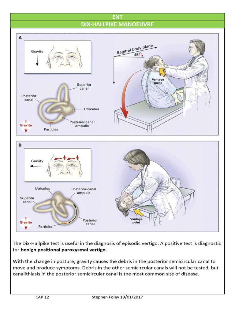 Dix Hallpike Test For BPPV | PDF | Vertigo | Neurological Disorders