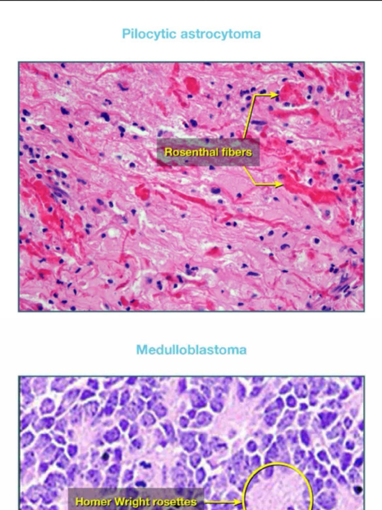 Brain Tumor @mbbsstudygroup | PDF