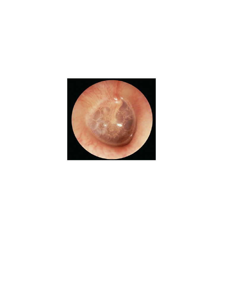 Ear and Nasal Conditions OSCE Guide | PDF