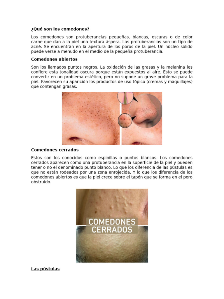 Comedones: Tipos y Características | PDF | Piel | Lesión