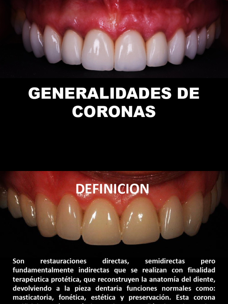 Generalidades sobre Coronas Dentales | PDF