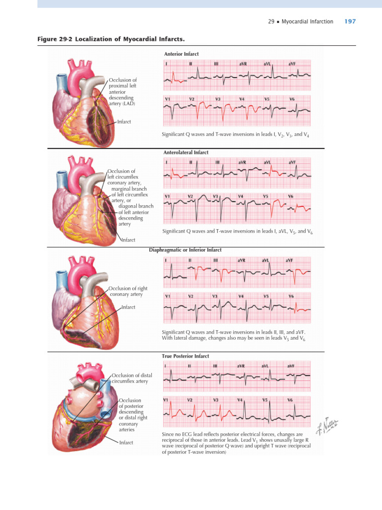 Localization of Myocardial Infarcts. | PDF