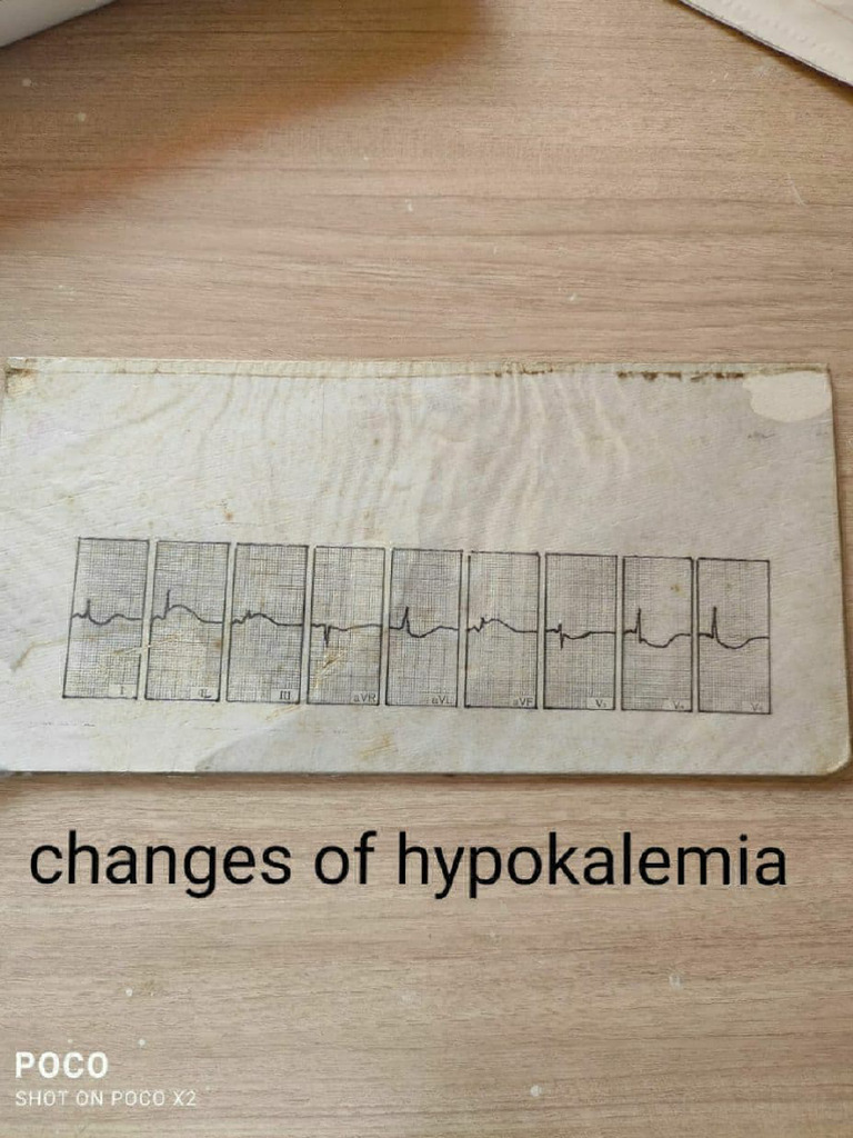 ECG Findings: Heart Block & Ischemia | PDF
