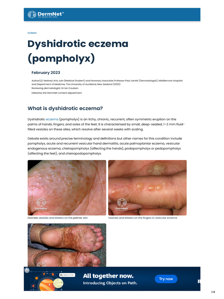 understanding-dyshidrotic-eczema-pdf-dermatitis-topical-medication