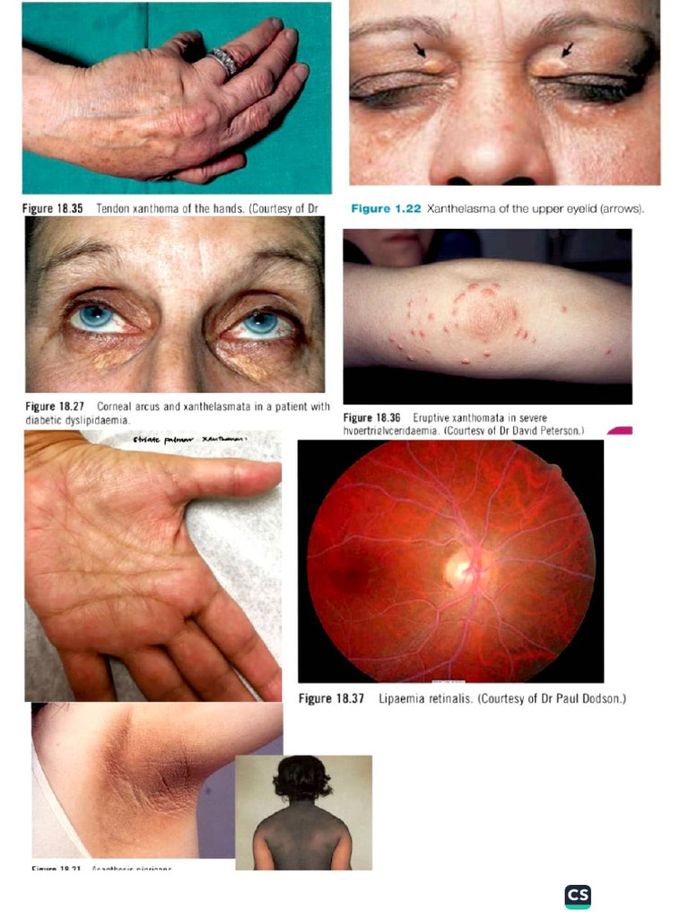 Dyslipidemia Cutaneous Manifestations | PDF