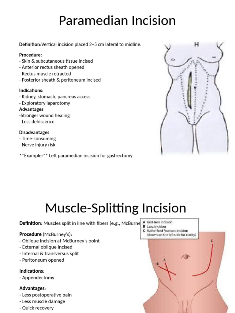 Paramedian Vs Muscle Splitting Incisions | PDF