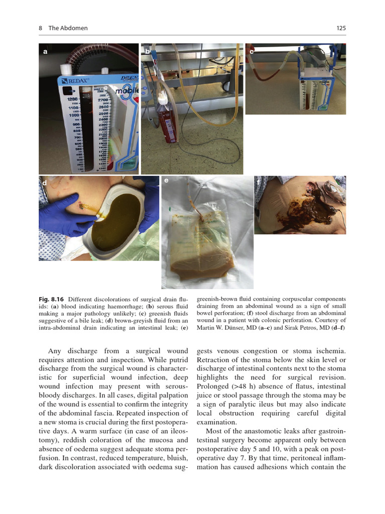 Postoperative Wound Inspection Guidelines | PDF | Liver | Edema