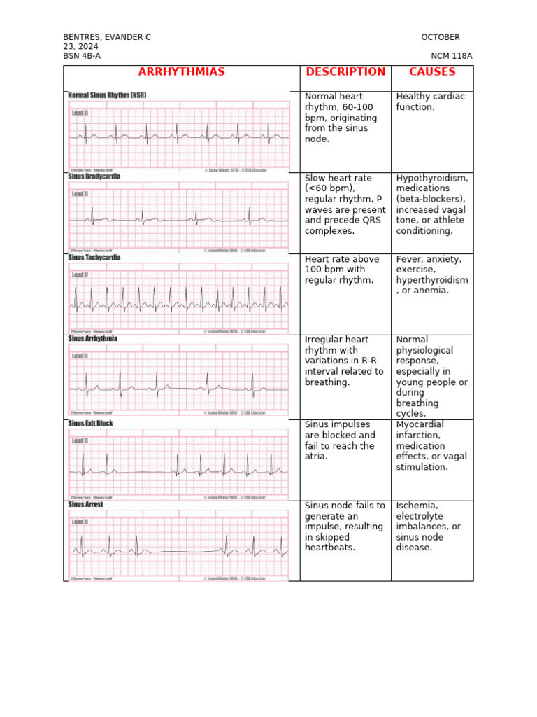 Arrhythmias | PDF | Heart Rate | Heart