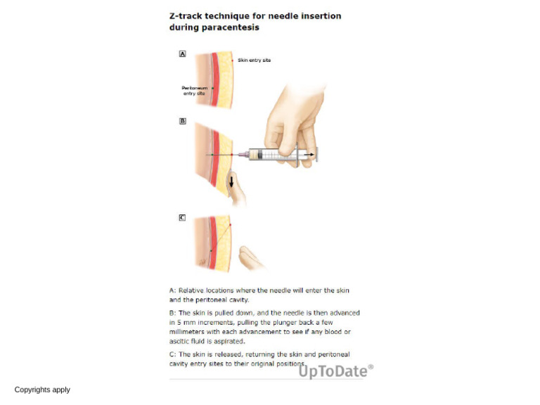 Z Track Technique | PDF