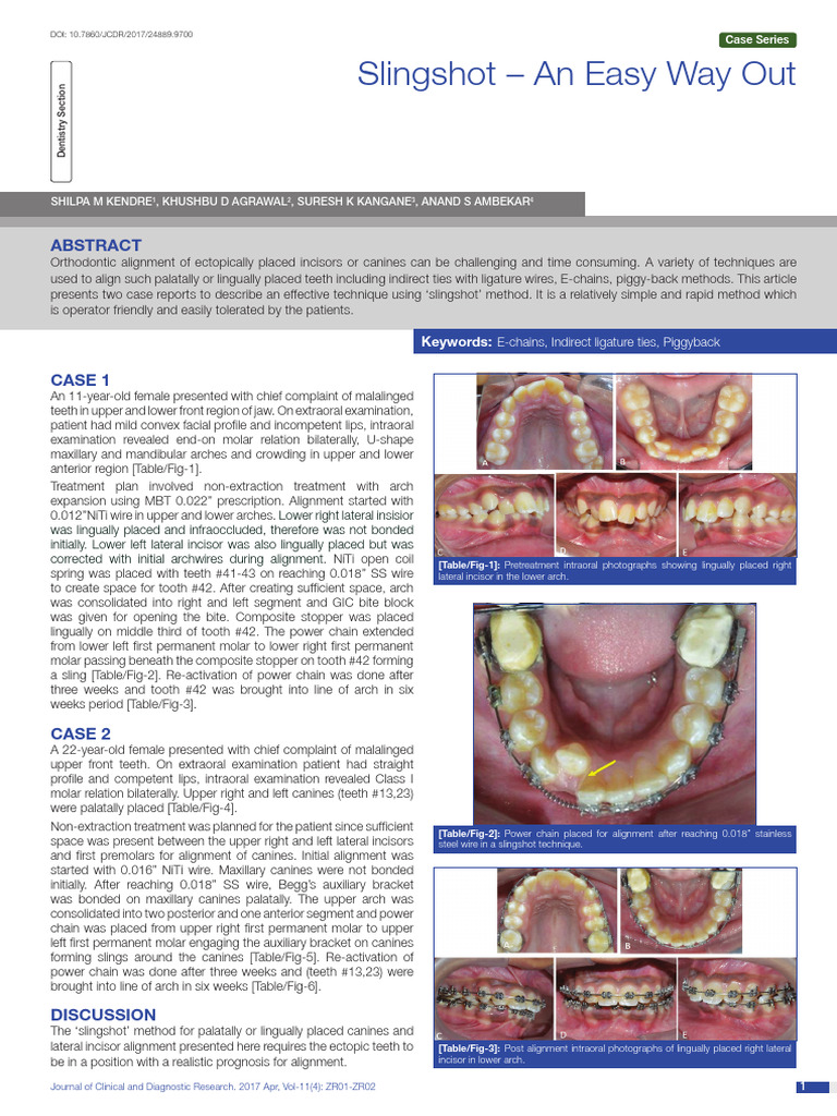 Slingshot Technique for Tooth Alignment | PDF | Tooth | Dentistry