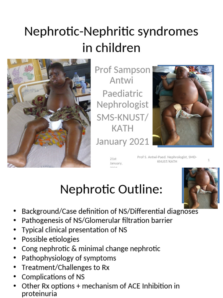 4. Nephrotic_nephritic Syndromes | PDF | Nephrology | Edema