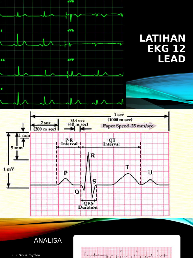 Ekg 12 Lead | PDF