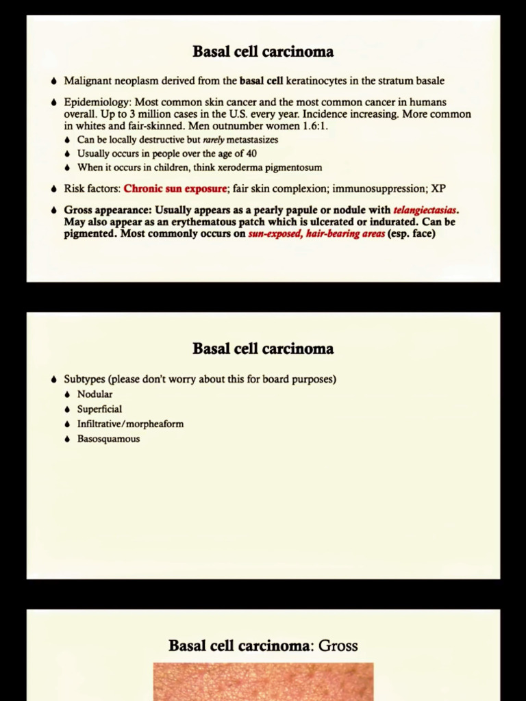 Basal Cell Carcinoma | PDF