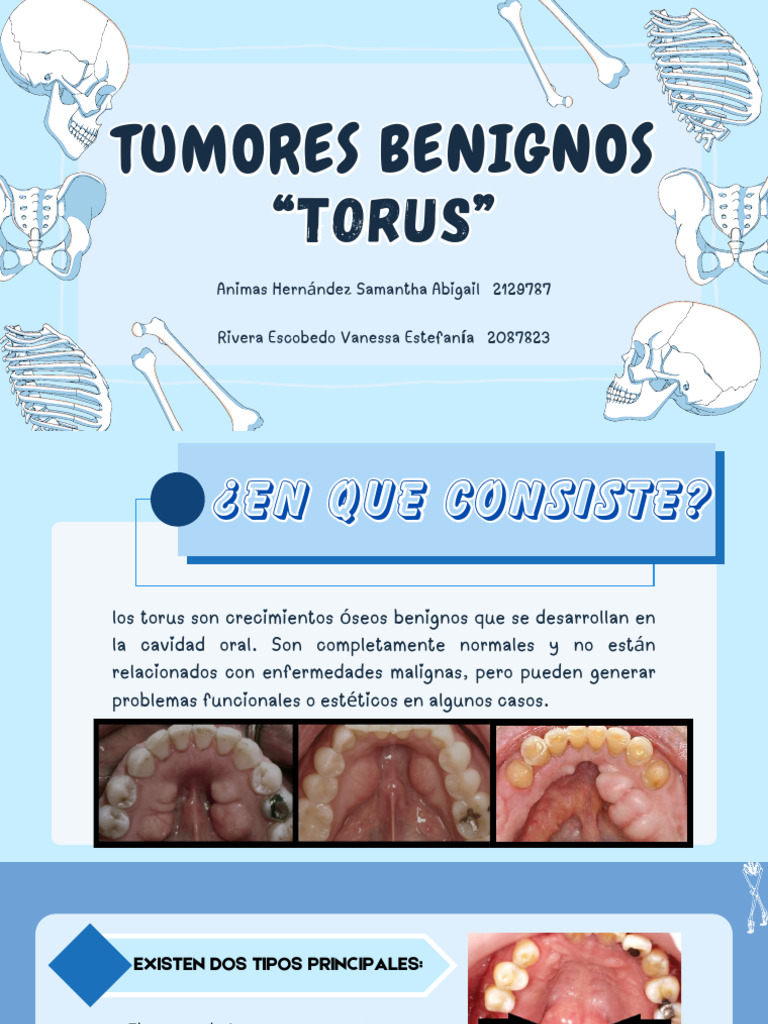 Torus Mandibular: Diagnóstico y Tratamiento | PDF | Odontología | Cáncer