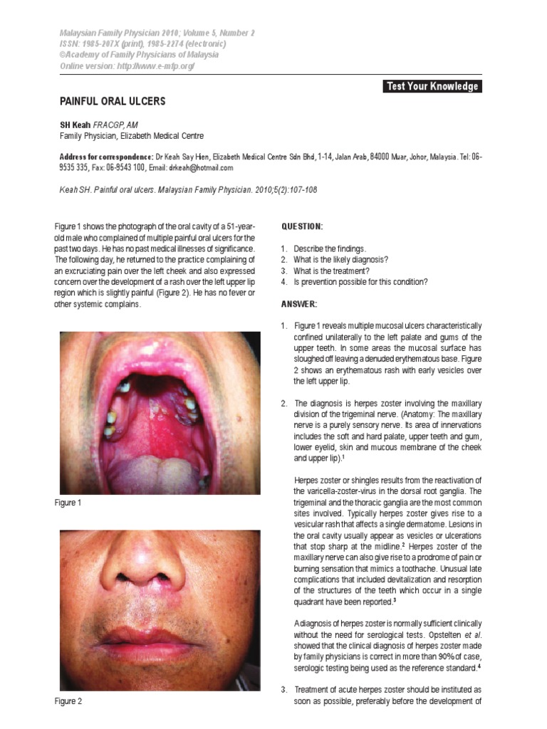 Oral Ulcers Herpes Simplex Diseases And Disorders
